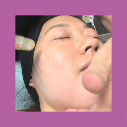 Crystal Microdermabrasion