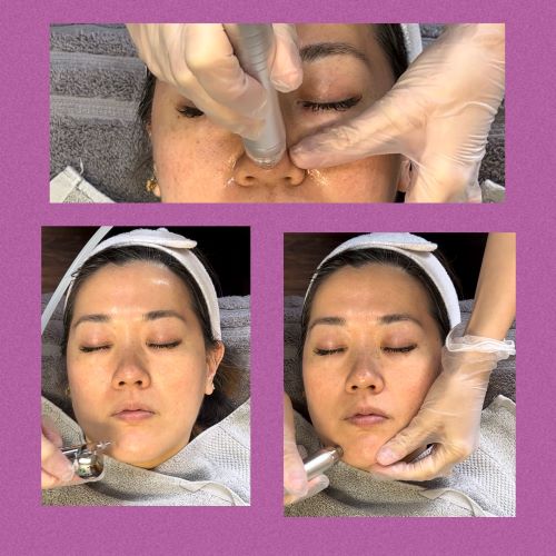 Hydra Dermabrasion with Oxygen