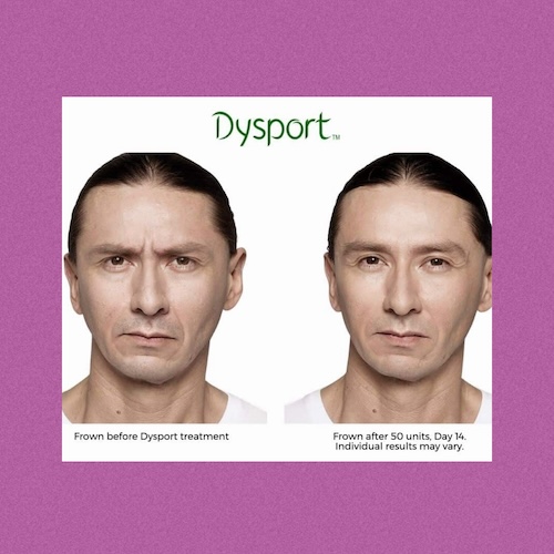 Dysport