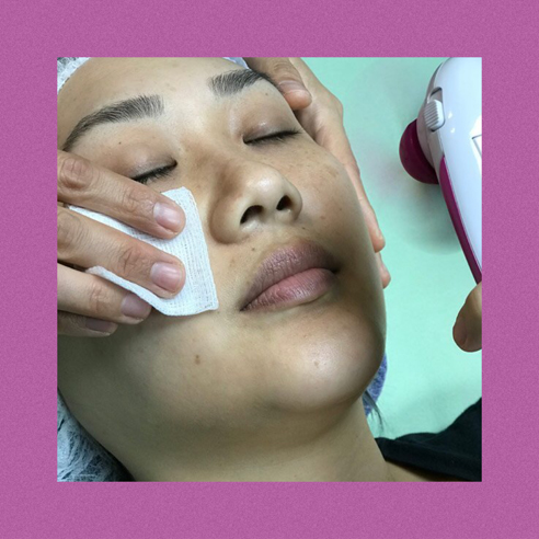 Hyperpigmentation Chemical Peels