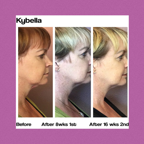 Kybella