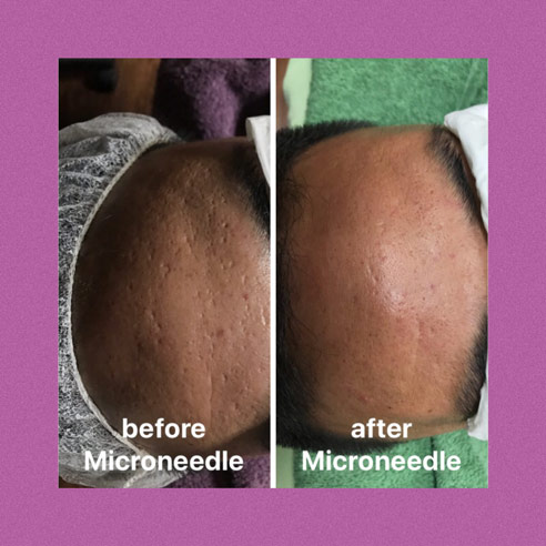Classic Microneedling for Moderate Acne