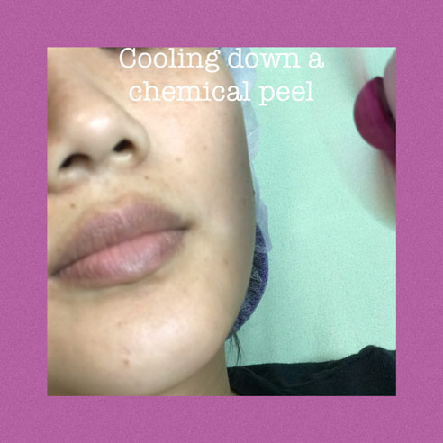 Chemical Peels for Dull Skin