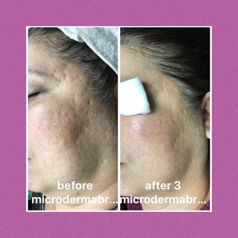 Crystal Microdermabrasion for Dull Skin