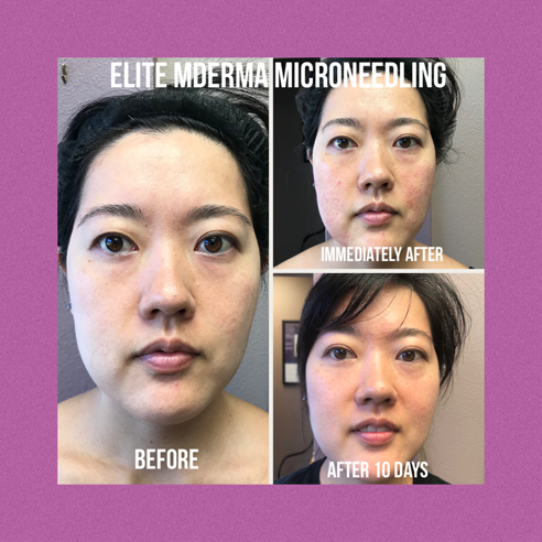 Elite MDerma Microneedling by DermaPen