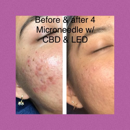 Acne Treament w CBD  and microneedle