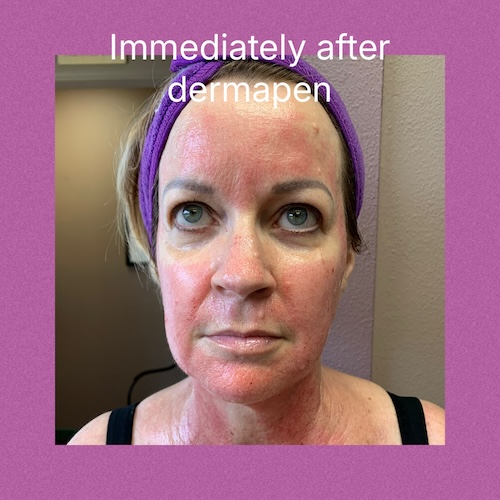 Elite MDerma Microneedling by DermaPen