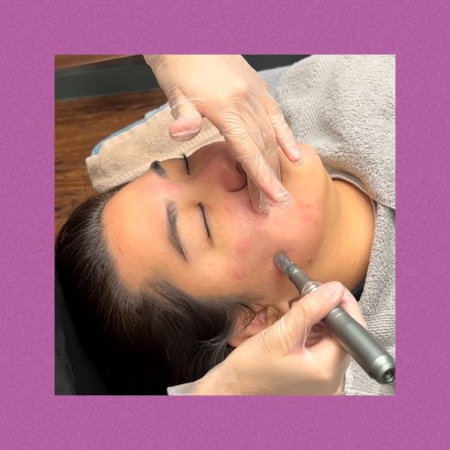 Classic Microneedling