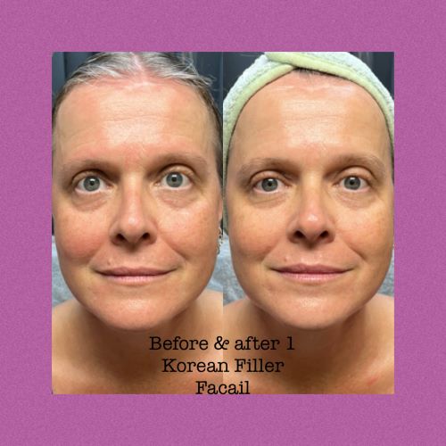 No Needle Filler Facial Treatment