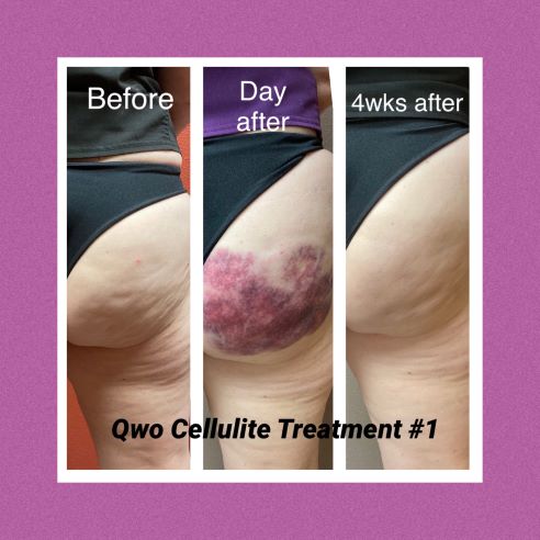 Qwo Cellulite Reduction Treatment 
