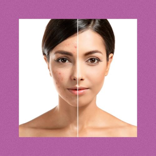 Acne Microneedling w/ CBD