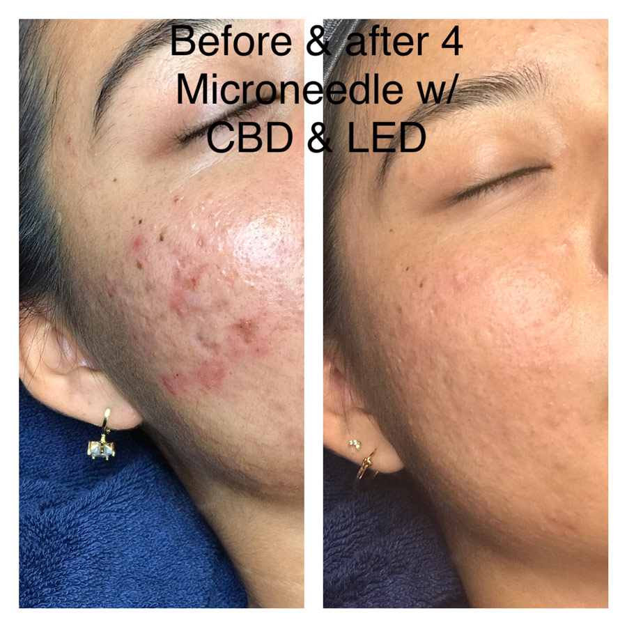Microneedling with CBD and LED- A Triple Punch Treatment for Acne