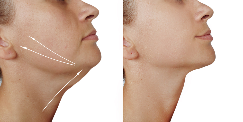 See Immediate Results With PDO Thread Lifting- The "Lunchtime Facelift"