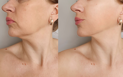 Discover Kybella: Say Goodbye to Your Double Chin